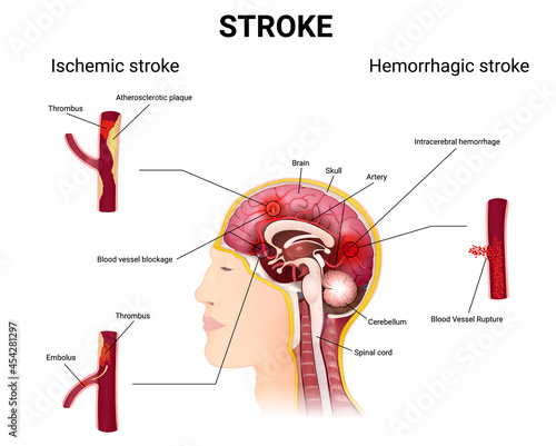 causes of stroke and the development of the disease