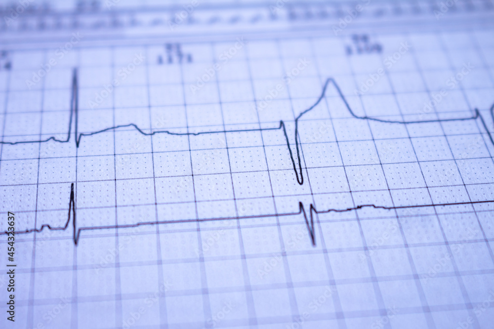 Heartbeat recorded on graph paper called an electrocardiogram. Study of the functioning of the heart post COVID-19.