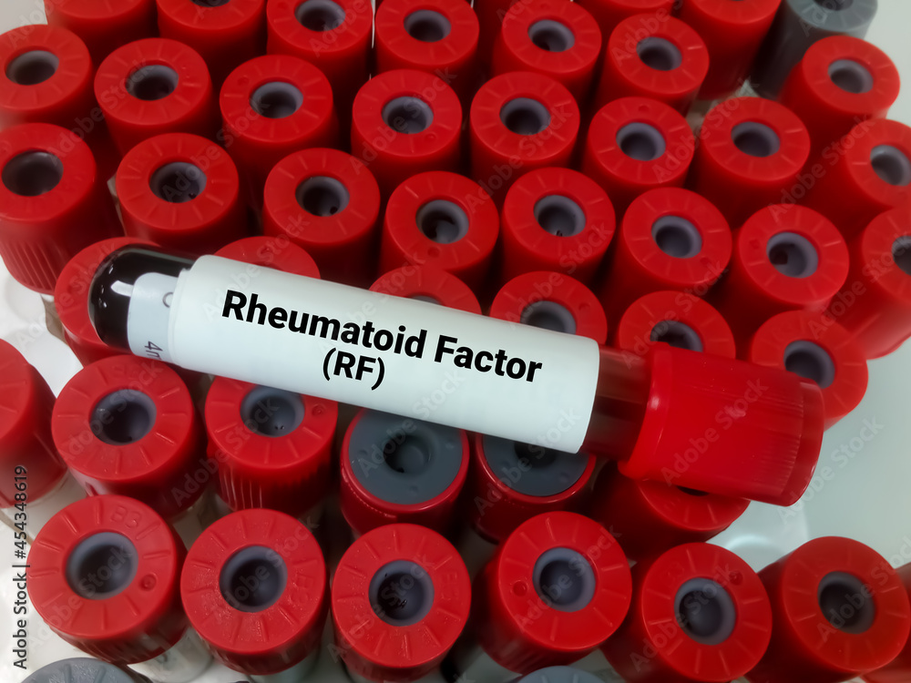 Blood sample for Rheumatoid factor (RF) test. Rheumatoid arthritis