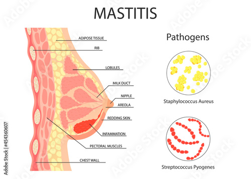 mastitis of the female breast. bacteria are pathogens. vector in cartoon simple style photo