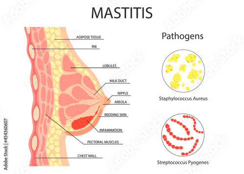 mastitis of the female breast. bacteria are pathogens. vector in cartoon simple style