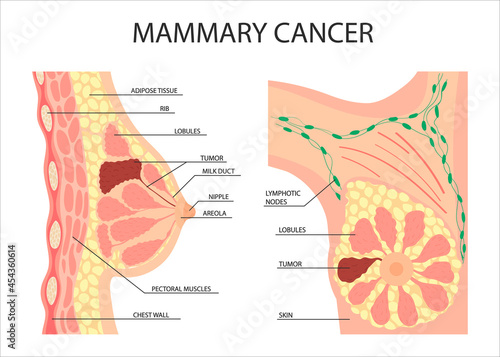 cancer of the female breast. A tumor or growth in the human breast. Anatomy of the nipple, lobule, duct in a female silhouette.