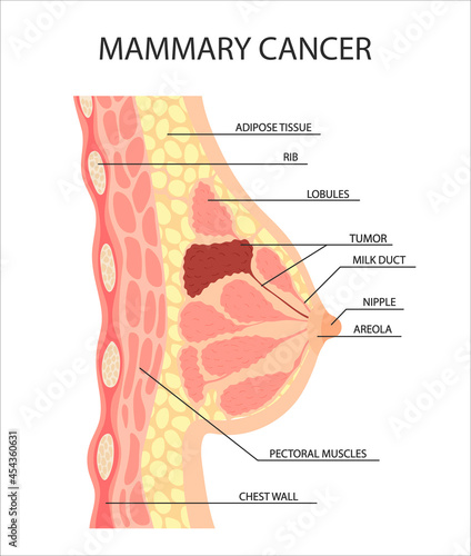 cancer of the female breast. A tumor or growth in the human breast. Anatomy of the nipple, lobule, duct in a female silhouette.