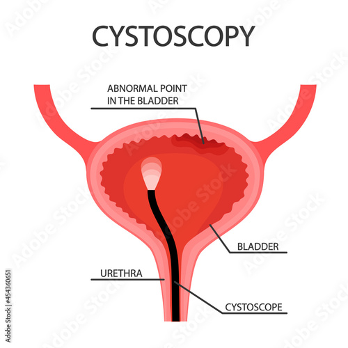 Cystoscopy diagnoses diseases and conditions of the bladder