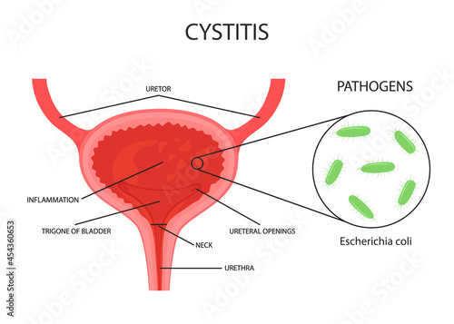 vector illustration of the bladder. cystitis