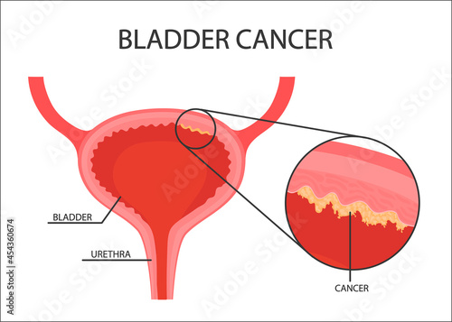 Human bladder cancer. malignant cells concept. Vector in cartoon style