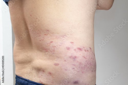 skin herpes zoster photo