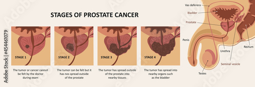 Stages of prostate cancer. Anatomy of the male reproductive system