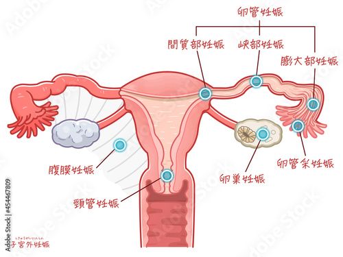 子宮外妊娠の子宮、卵巣、卵管、妊娠する場所のイラスト、illustration photo