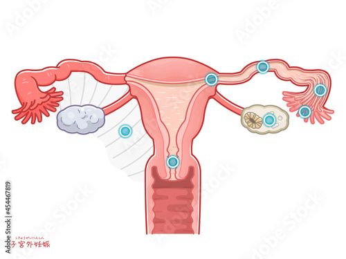 子宮外妊娠の子宮、卵巣、卵管、妊娠する場所のイラスト photo