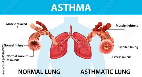 Asthma diagram with normal lung and asthmatic lung