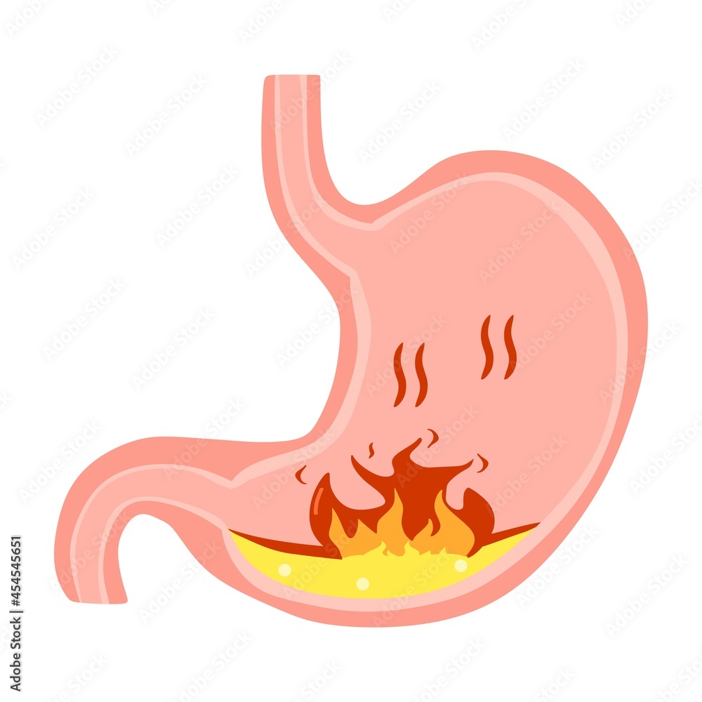 Vector illustration of a stomach showing an ulcer or illness, perfect for advertising health and education products