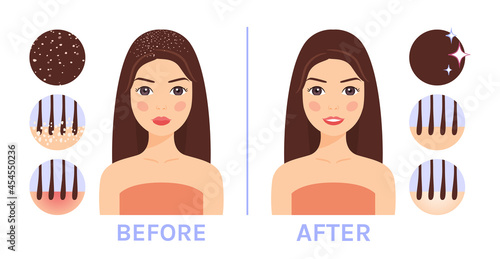Beautiful Brunette Woman with Dandruff on Hair. Treatment of Scalp. Before and After. Seborrhea Icons. Happy Lady with Clean Hair, with a Smile on Face. Cartoon Style. White background. Vector image