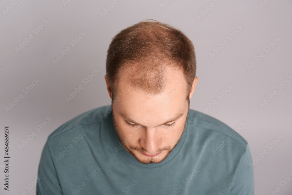 Man with hair loss problem on grey background, above view. Trichology treatment Man with hair loss problem on grey background, above view. Trichology treatment