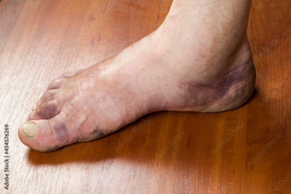 Swollen foot of a man's leg after a fracture. Purple bruise on human