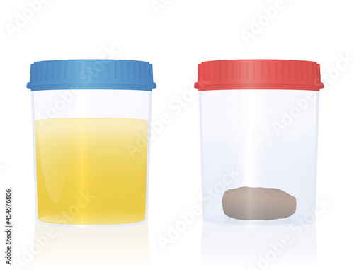 Urine and fecal sample in specimen cups with blue and red cap for urological analysis and medical examination. Isolated vector illustration on white background.
 photo