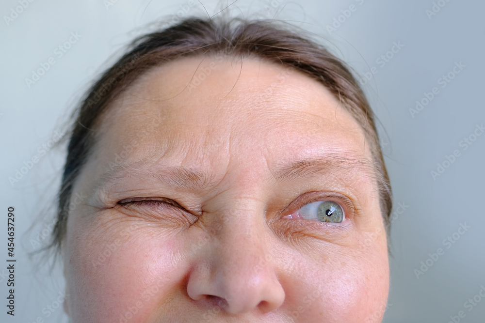 upper part of woman's face, an elderly woman close-up, small and large mimic wrinkles, eyes with spots, concept of poor vision, eye fatigue, drooping eyelid, correction of elasticity of aging skin upper part of woman's face, an elderly woman close-up, small and large mimic wrinkles, eyes with spots, concept of poor vision, eye fatigue, drooping eyelid, correction of elasticity of aging skin