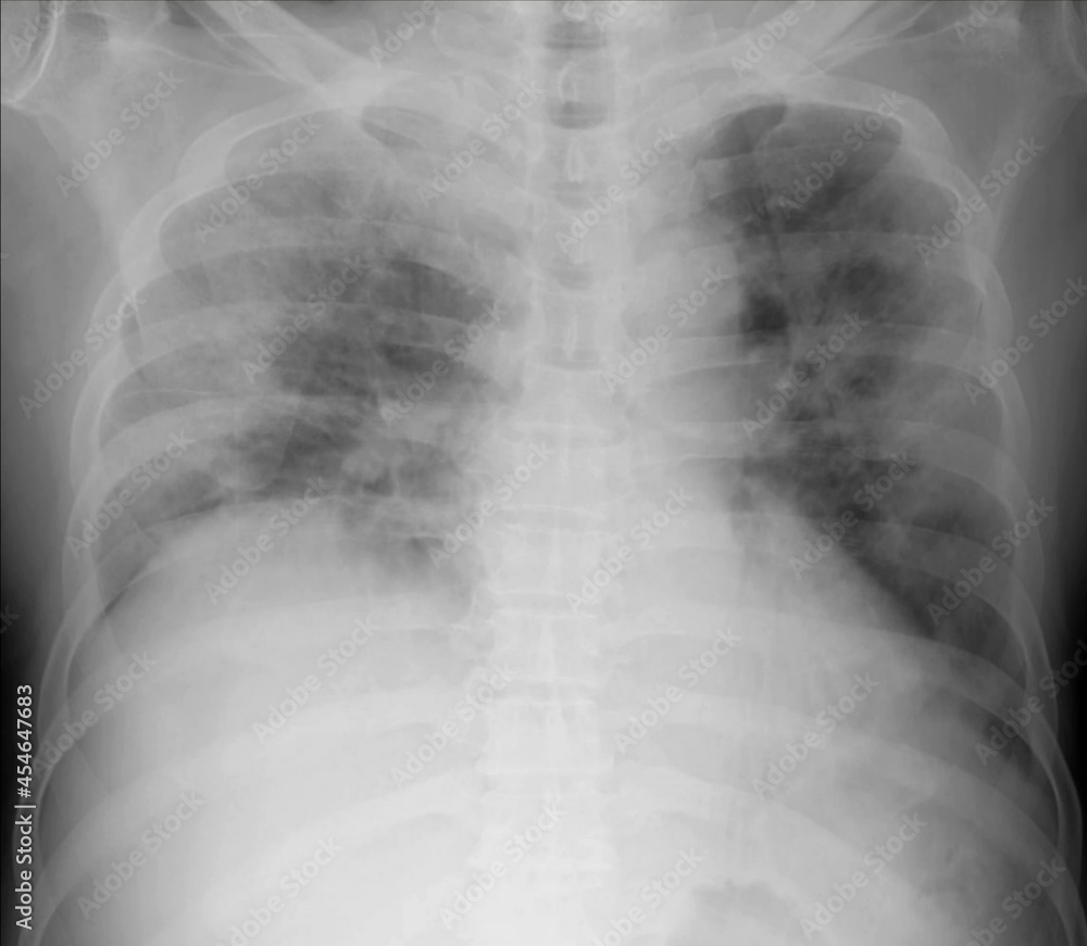 x ray of a covid19 pneumonia radiology image x ray of a covid19 pneumonia radiology image