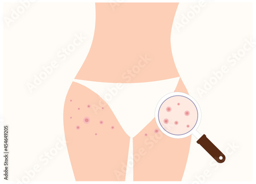 Pimples on buttocks and zoom with magnifier. Skin care concept.