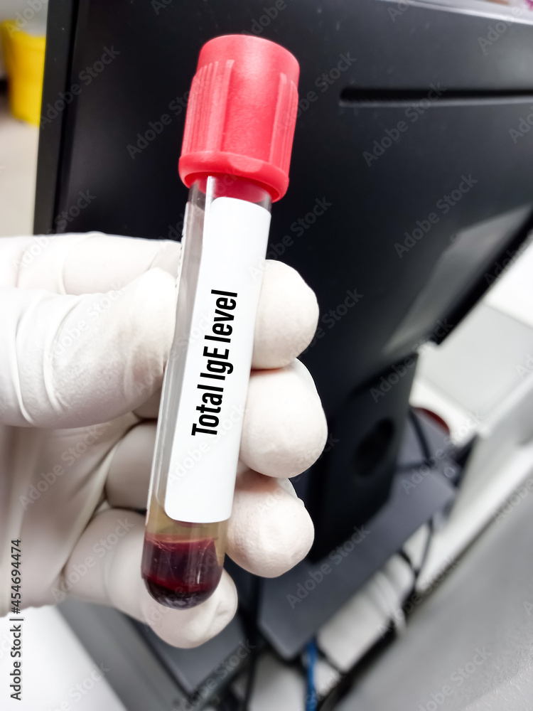 Blood sample for Total IgE or Immunoglobulin E level, Allergy testing for detect allergen substance cause allergic reaction Blood sample for Total IgE or Immunoglobulin E level, Allergy testing for detect allergen substance cause allergic reaction