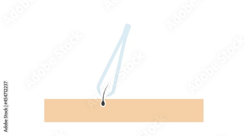 Illustration of tweezers and hair on the skin. Vector isolated editable flat illustration