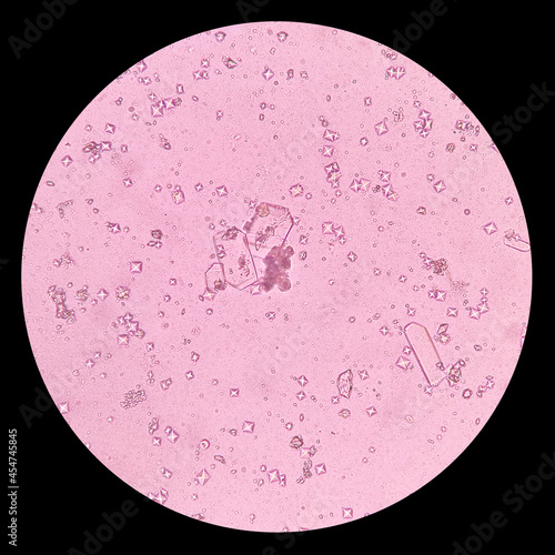 Quadro em tela Light microscope of calcium oxalate crystals are shaped like envelopes