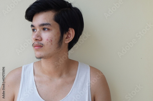 Young man 15 year old. With full face of acne problem or pimple on face Asian young boy photo