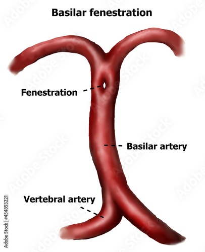 The BA fenestration is the variation of BA which can develop to be BA aneurysm. photo