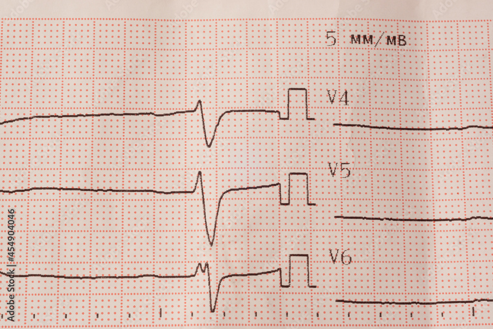 Close view of electrocardiogram with heart rate readings