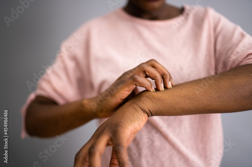 Tableau sur toile African American Woman With Itchy Skin