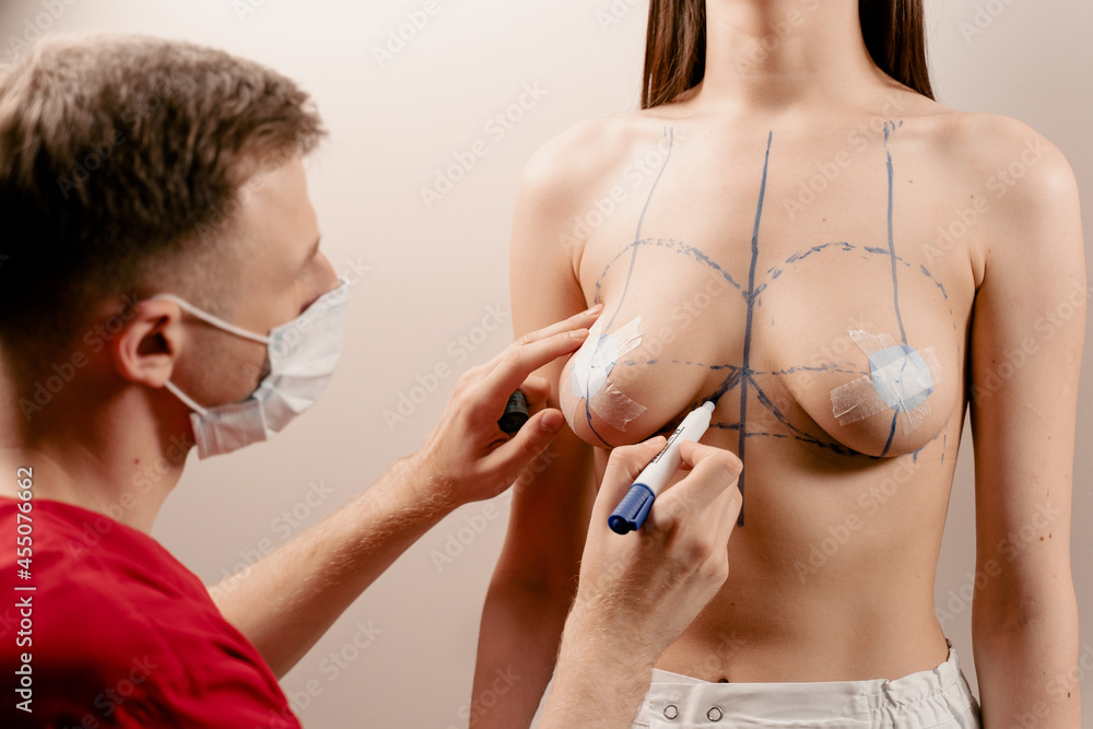 Drawing a marking line on the chest of a young girl. Breast augmentation surgery markup. Drawing a marking line on the chest of a young girl. Breast augmentation surgery markup.