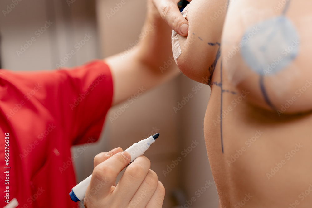 Drawing a marking line on the chest of a young girl. Breast augmentation surgery markup. Drawing a marking line on the chest of a young girl. Breast augmentation surgery markup.