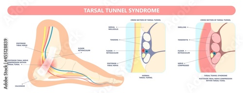 Tarsal tunnel syndrome flat feet flatfoot tibial tear running ankle bone tendon nerves pain foot compresses fallen arches vein cyst swollen spur carpal heel injury trauma torn inflamed adult photo