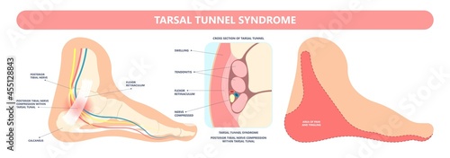 Tarsal tunnel syndrome flat feet flatfoot tibial tear running ankle bone tendon nerves pain foot compresses fallen arches vein cyst swollen spur carpal heel injury trauma torn inflamed adult photo