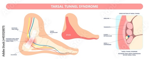 Tarsal tunnel syndrome flat feet flatfoot tibial tear running ankle bone tendon nerves pain foot compresses fallen arches vein cyst swollen spur carpal heel injury trauma torn inflamed adult