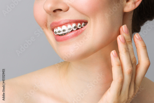 Orthodontic Dental Care Concept. Woman Healthy Smile close up. Closeup Ceramic and Metal Brackets on Teeth. Beautiful Female Smile with Braces.