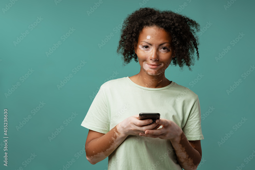 Young woman with vitiligo using mobile phone and smiling Young woman with vitiligo using mobile phone and smiling