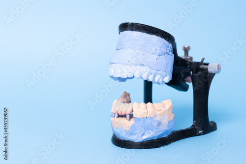 Tooth recovery with implant. Plaster model of teeth. Upper and lower jaws plaster model with prepared teeth. White front teeth veneers on diagnostic model. Concept of aesthetic dentistry. Concept of