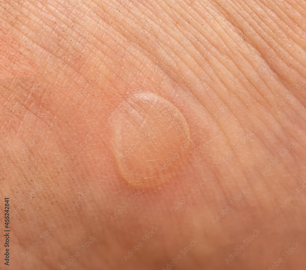 calluses on the skin of the feet as a background