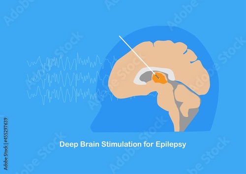 Deep brain stimulation or DBS for treatment epilepsy or seizure