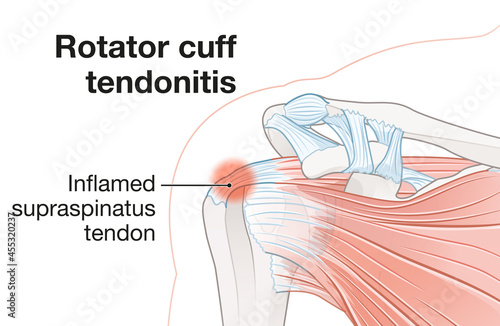 Obraz na płótnie Shoulder anatomy. Rotator cuff tendonitis