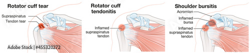 Fotografie Shoulder pain. Rotator cuff tear. Tendonitis. Bursitis