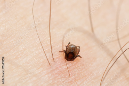 Tick on a human skin