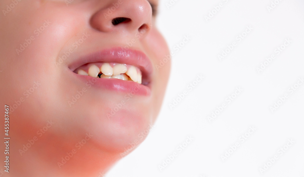 Obraz premium The girl knocked out two front teeth. Teeth augmentation.