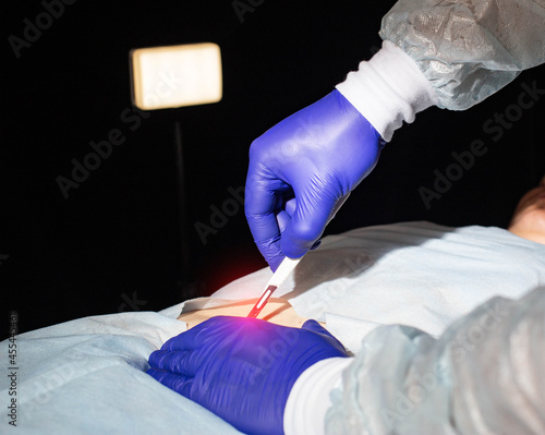 Φωτογραφία Doctor surgeon with a scalpel in his hand before bowel surgery in a patient, close-up