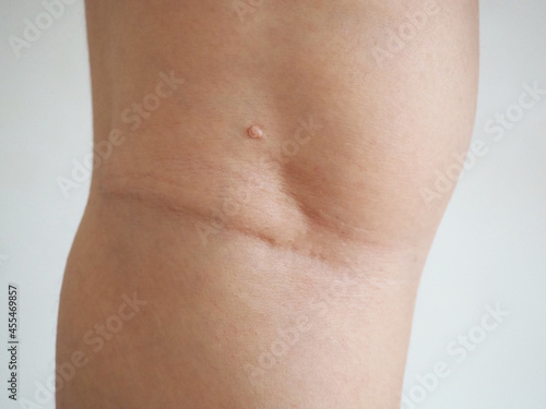 Closeup blurred, mole of skin lesion cause of proliferation of pigment derma cells and melanocytic pigmented naevus on the woman leg.