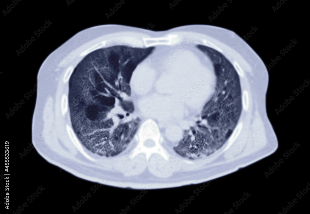CT scan of Chest or lung axial view of lung infection covid-19 with ground glass opacity isolated on black background. clipping path. CT scan of Chest or lung axial view of lung infection covid-19 with ground glass opacity isolated on black background. clipping path.