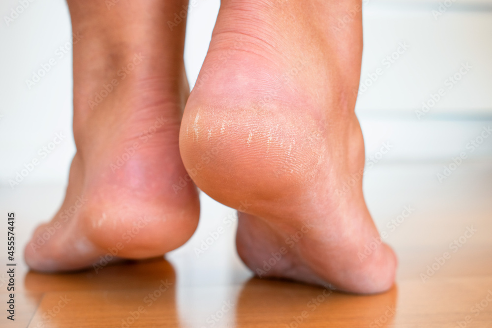 Before and after foot care. Concept of feet healthcare, foot bath and removal of cracked heels. Cracked heels due to incorrect body weight distribution. Neglected, poorly cared for and aching feet. Before and after foot care. Concept of feet healthcare, foot bath and removal of cracked heels. Cracked heels due to incorrect body weight distribution. Neglected, poorly cared for and aching feet.