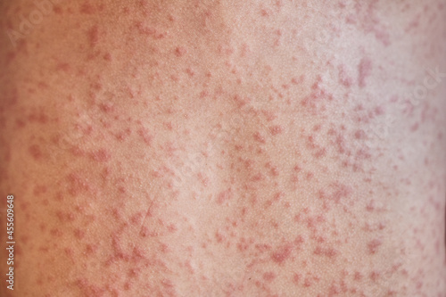 allergic rash on the body of the patient. 5 year old girl. 