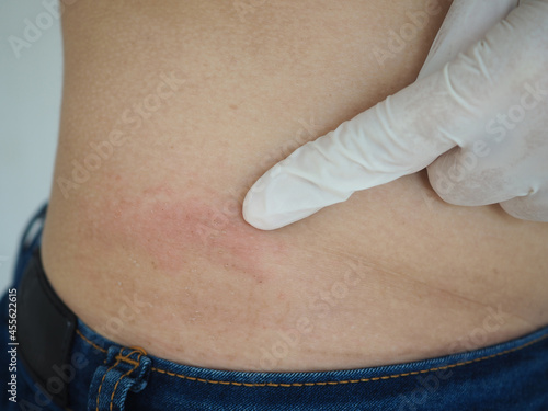 Rash on a woman's stomach. concept of skin disease. photo